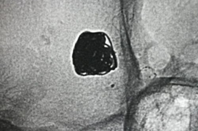 造影视频全过程